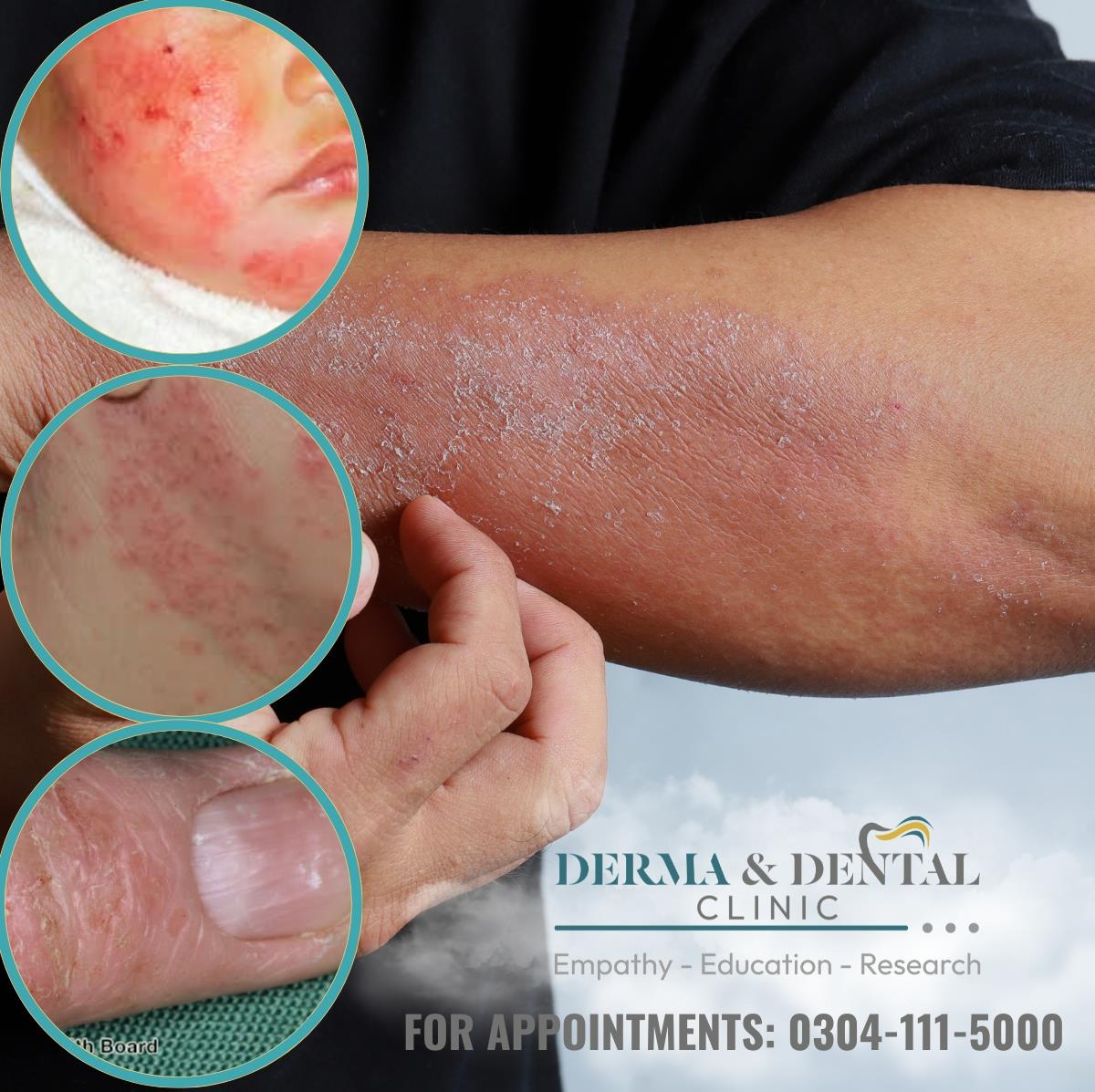 Conquer Atopic Eczema with Expert Dermatologists at Derma & Dental Clinic
