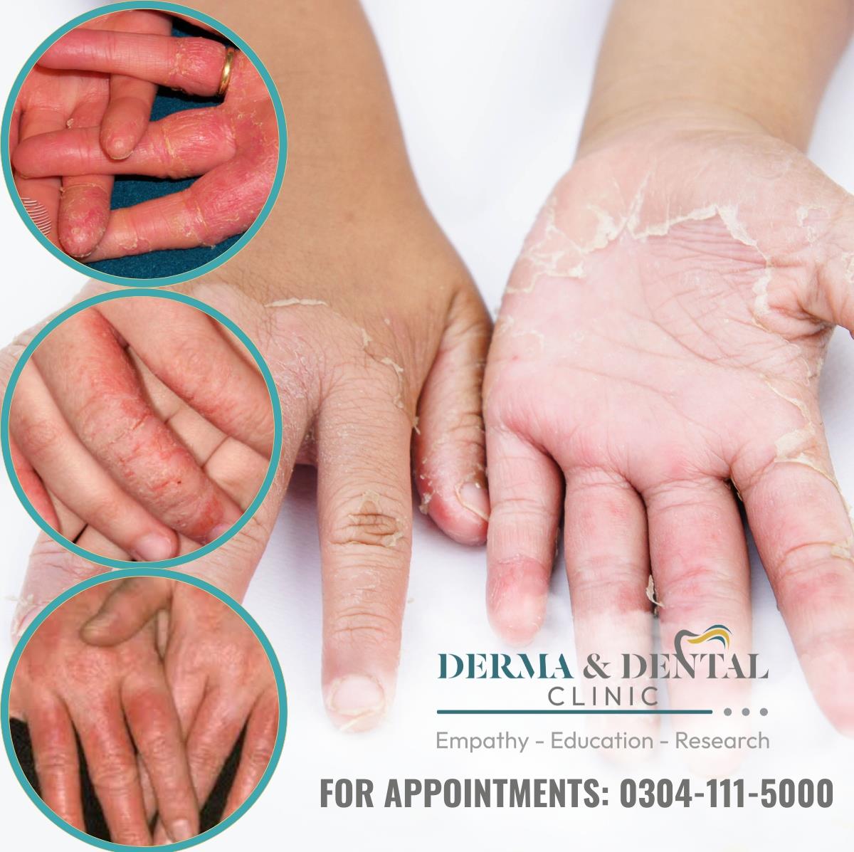 Contact Eczema Treatment at Derma & Dental Clinic Say Goodbye to Skin