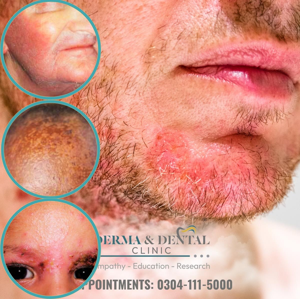 Seborrheic Eczema Treatment By Dermatology Experts At Derma And Dental Clinic